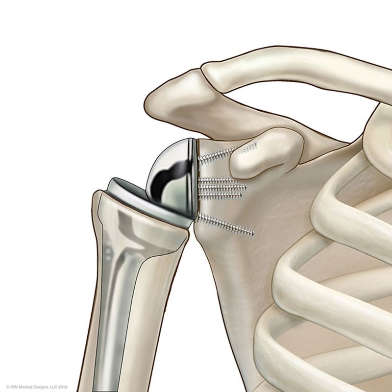​Total Reverse Shoulder Replacement