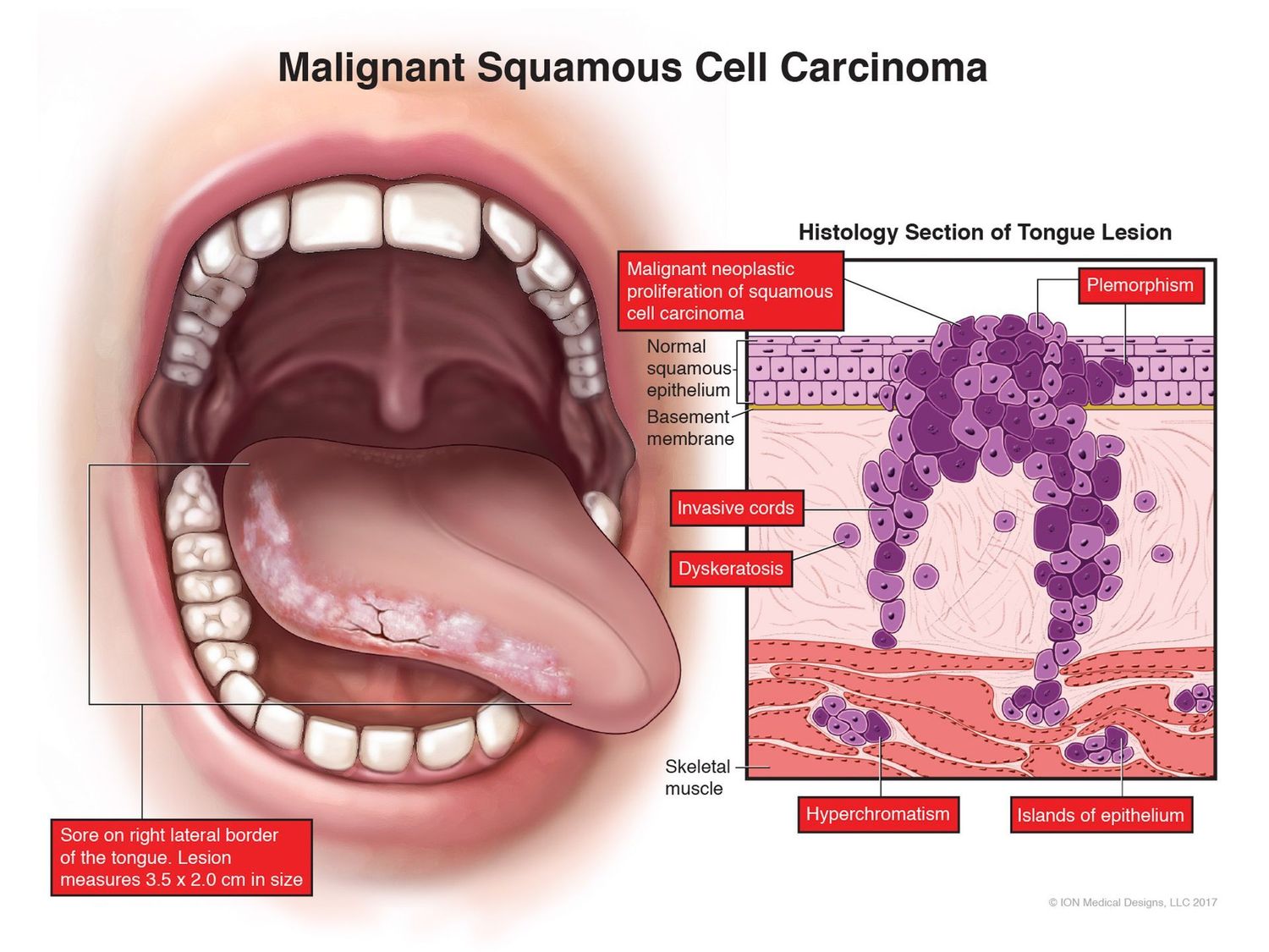 ​Malignant Squamous Cell Carcinoma
