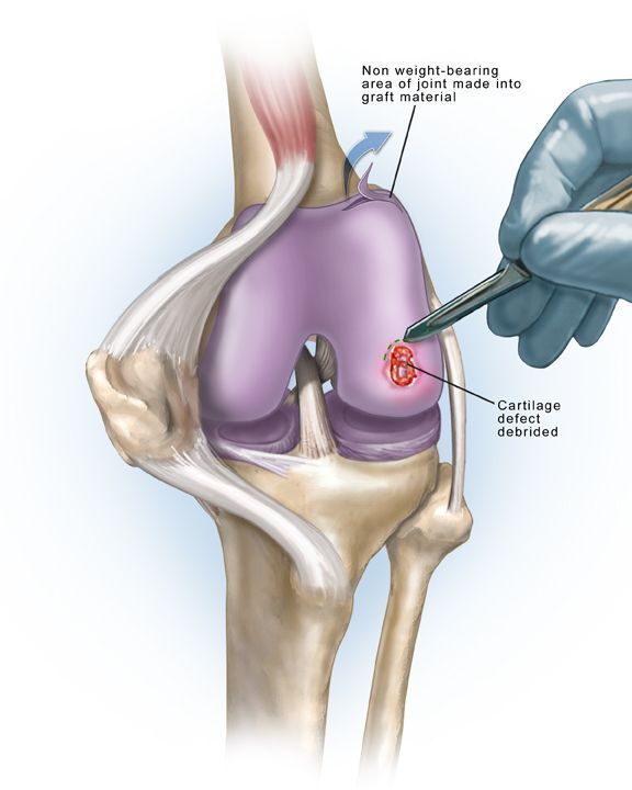 Debridement