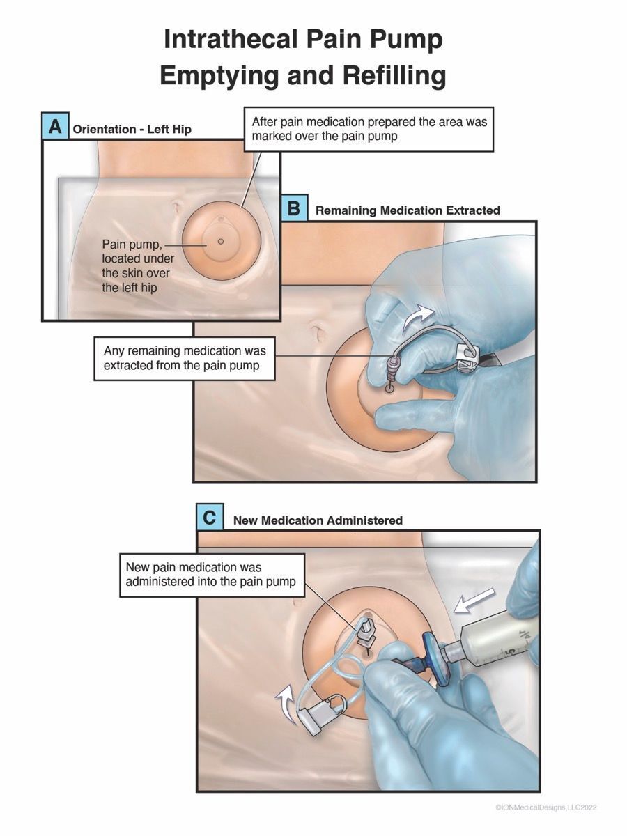 Intrathecal Pain Pump, Emptying and Refilling