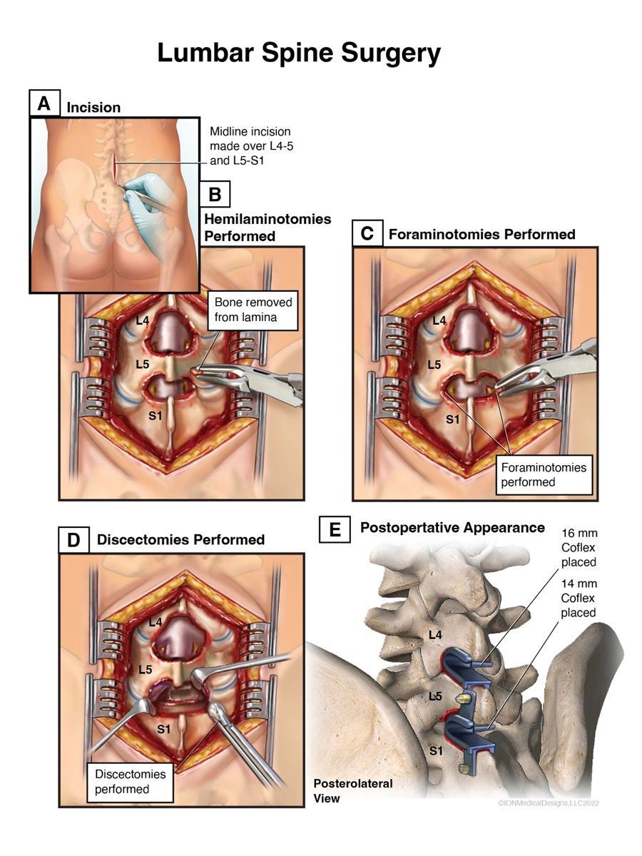 Lumbar Spine Surgery