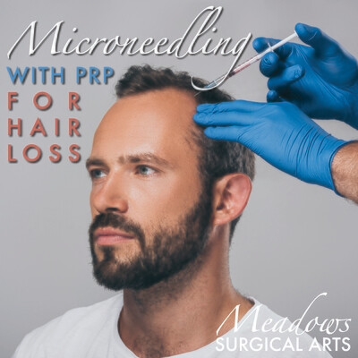 Microneedling with PRP for Hair Loss