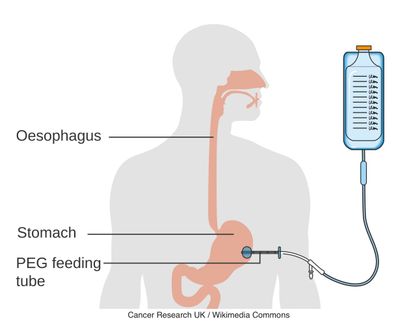 PEG Feeding