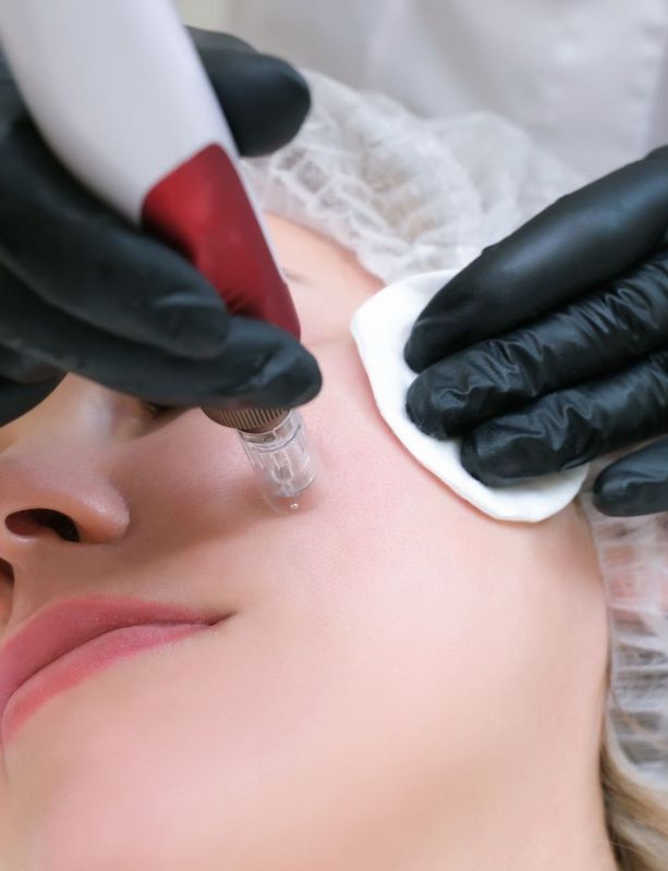 Microneedling Course (Online Training)