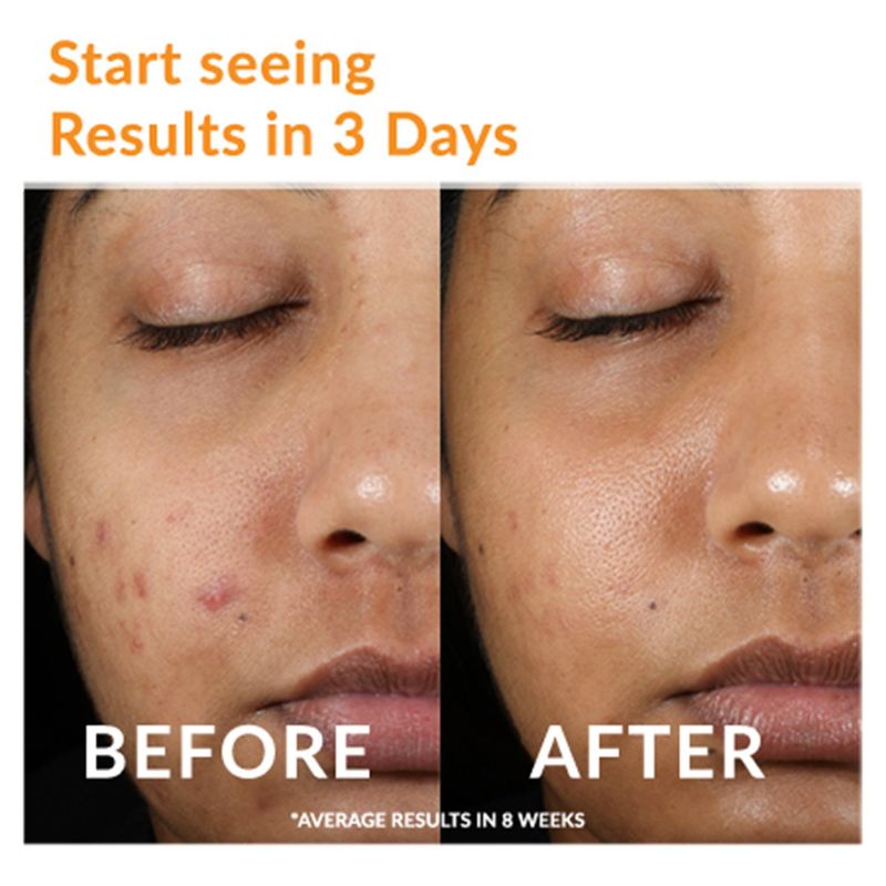Acne Free Oil Free Acne Cleanser, 8 fl oz