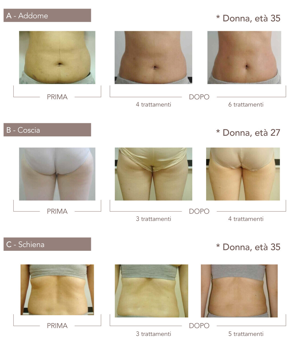 T Shape Addome E Fianchi