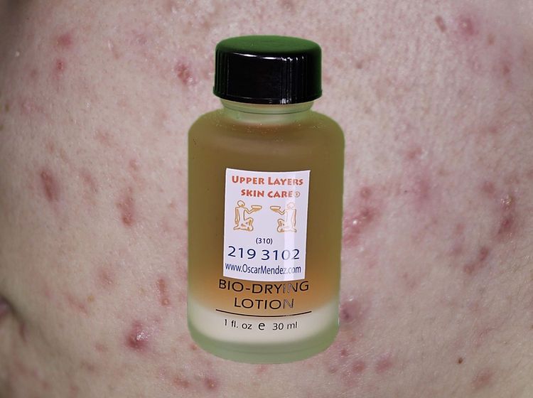 Bio Drying Lotion