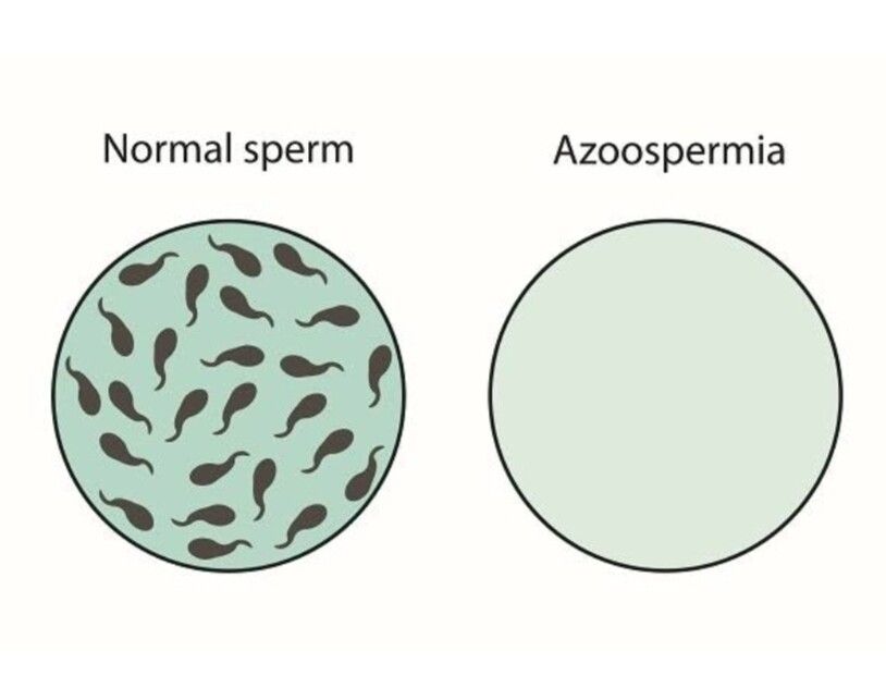 Azoospermia treatment pack