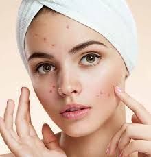 Acne & Blemishes