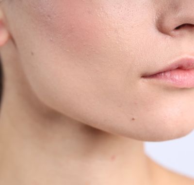 Sensibile / Arrossata