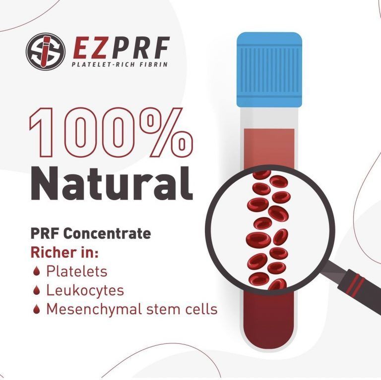 PRF (Platelet-Rich Fibrin)