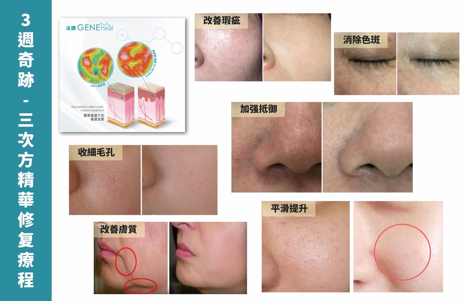 GENEheal 三週奇蹟「加強・升級・亮澤青春方案」《軒仔推介》