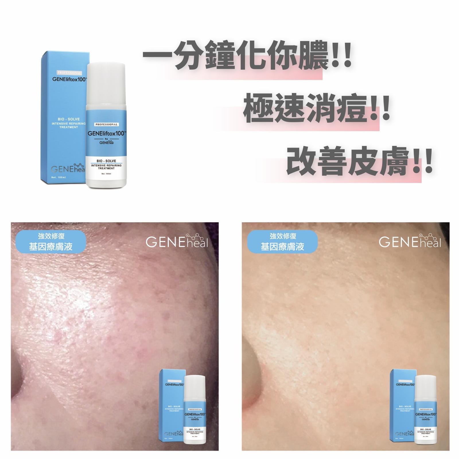 <軒仔推介> GENEheal Bio Intensive Repairing Treatment 「強效修復基因療膚液」