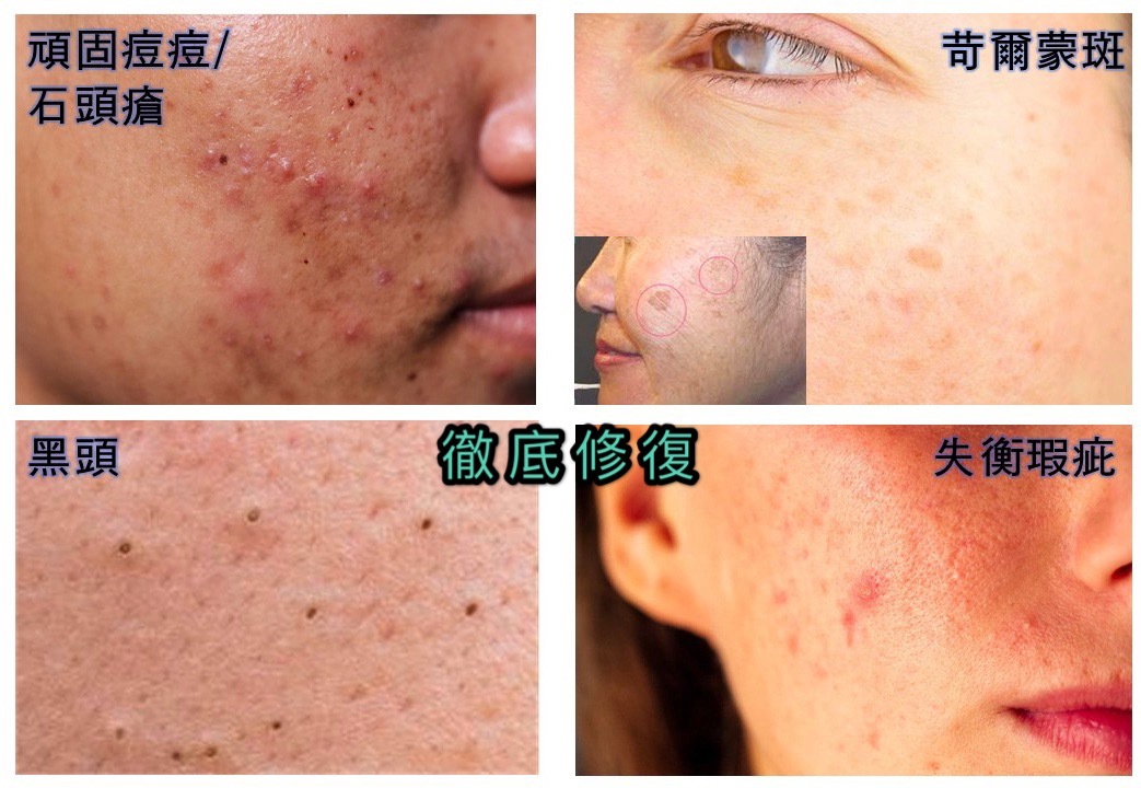 GLOBAL REJUVENATION SERUM - GENELIFTOX100
全效煥膚無瑕嫩肌精華 - 因子昇華能量100《Roseann愛心推介》