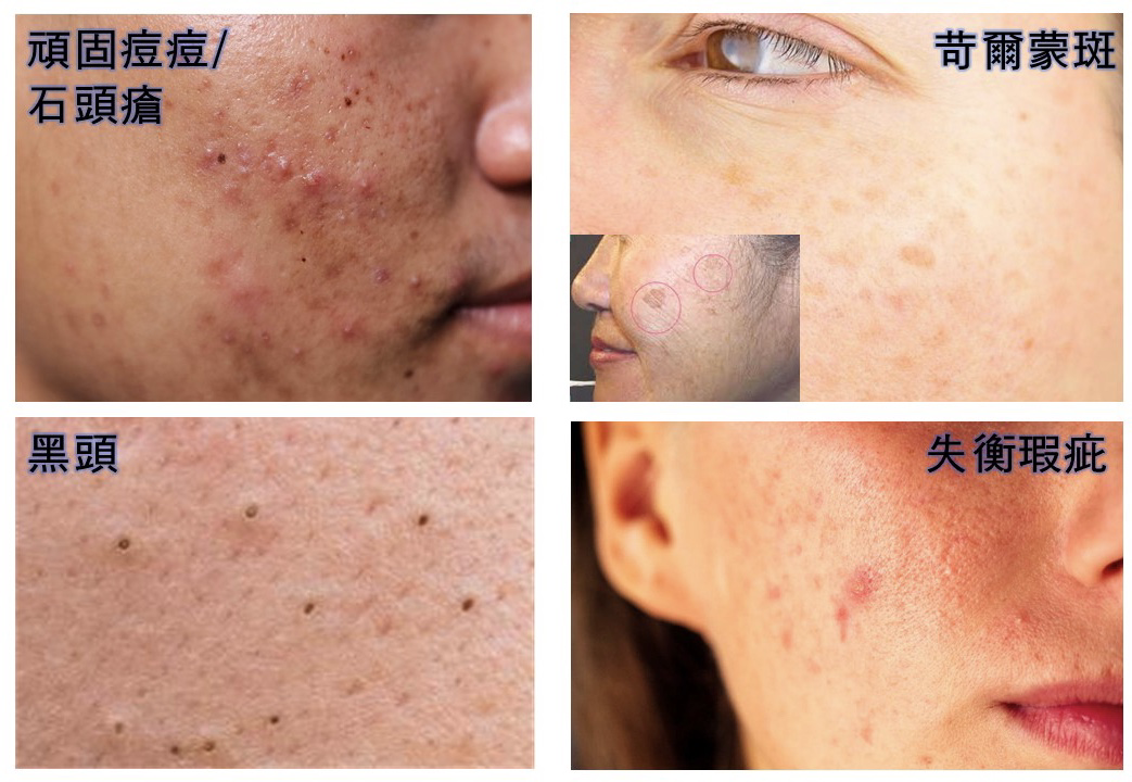 <NEW> GLOBAL REJUVENATION SERUM - GENELIFTOX100
全效煥膚無瑕嫩肌精華 - 因子昇華能量100