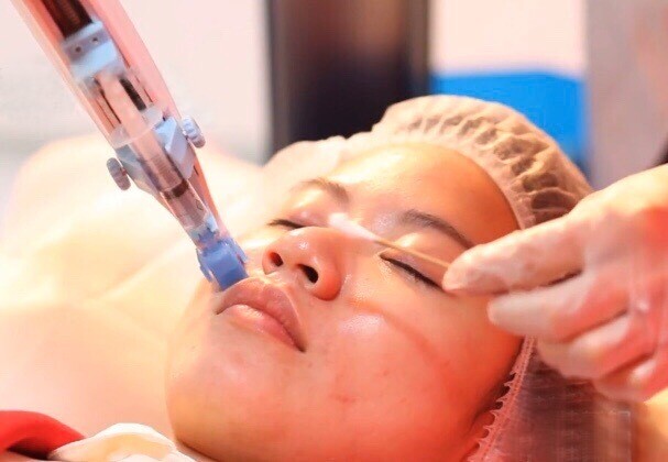 71% OFF Two (2) Microneedling Treatments with Vitamin and Hydration Therapy for NEW clients ... (Reg $599.00)