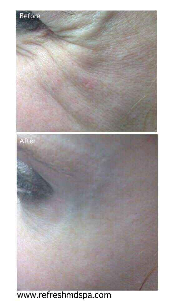 Before &amp; After - Crowsfeet