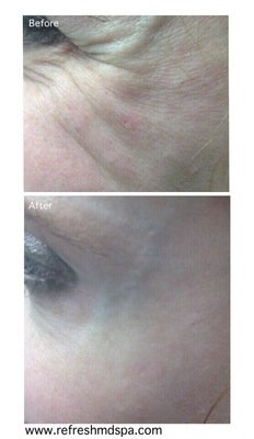 Before &amp; After - Crowsfeet