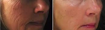 71% OFF Two (2) Microneedling Treatments with Vitamin and Hydration Therapy for NEW clients ... (Reg $599.00)