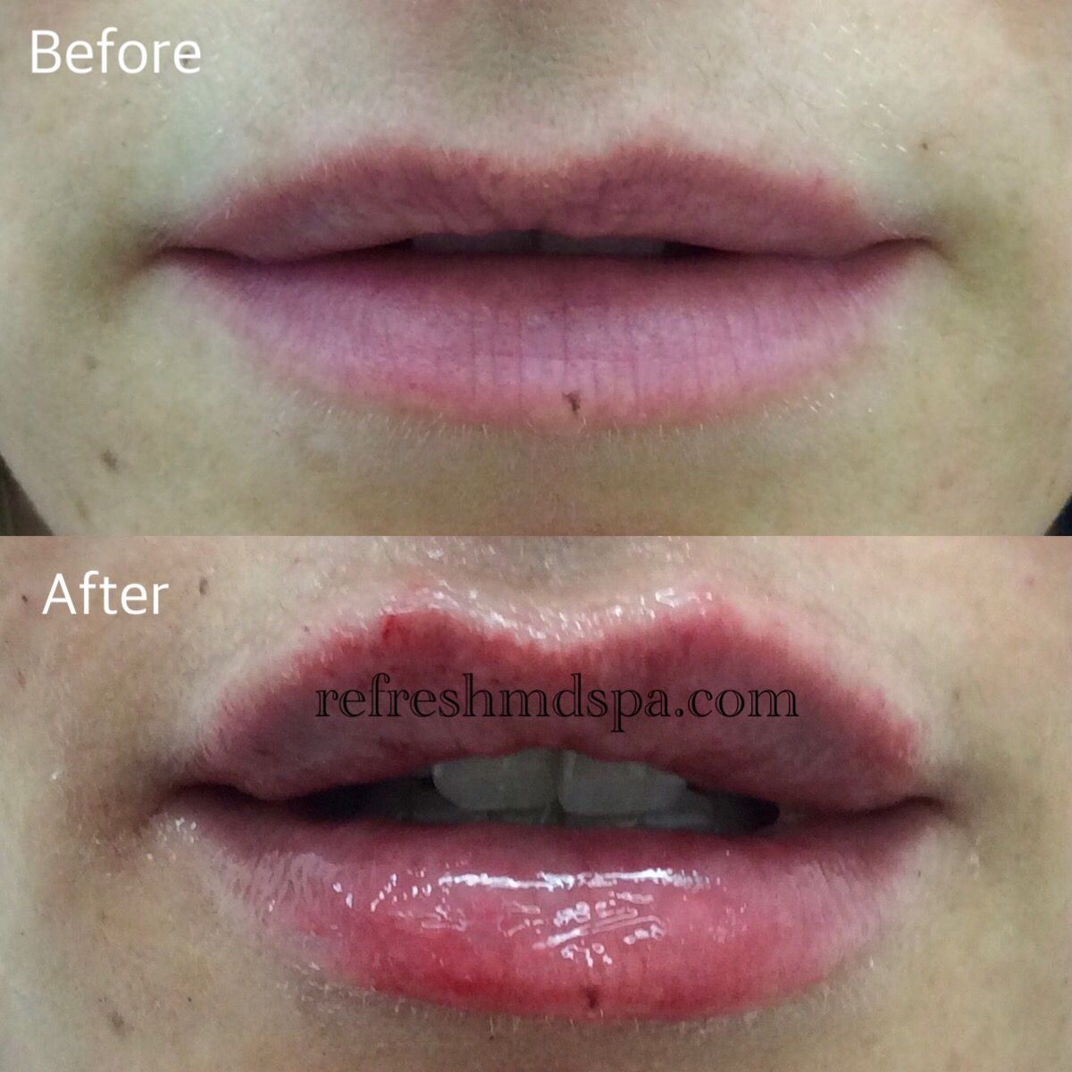 HALF Syringe of a Volume Filler ... (Reg $499) ... 45% OFF!