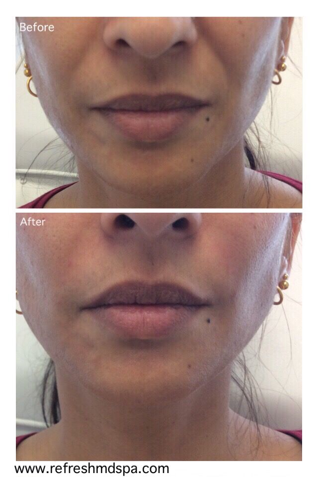 1 FULL Syringe of a Volume Filler ... (Reg $799) ...45% OFF