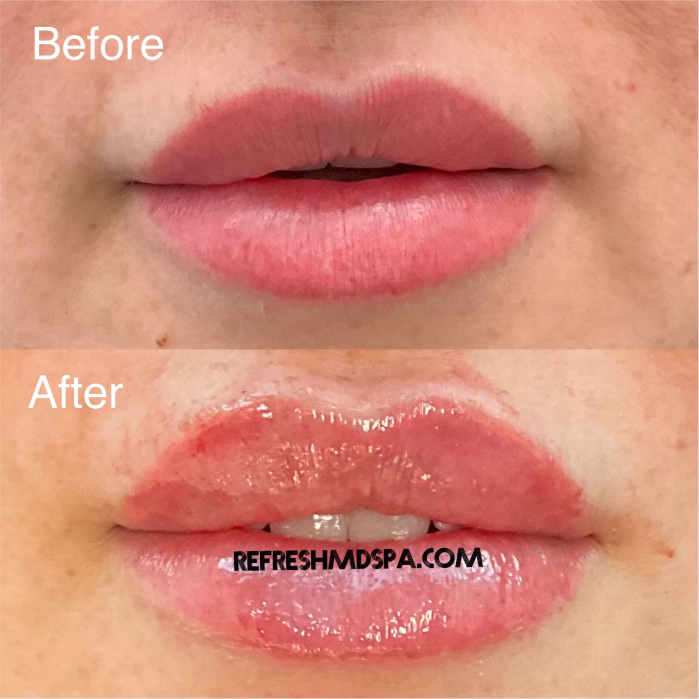 1 BASIC Dermal Filler 1.0 ml Syringe for NEW CLIENTS ... (Reg $649.00)