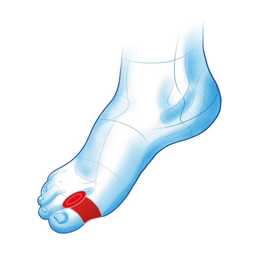 Klin z pierścieniem na haluks