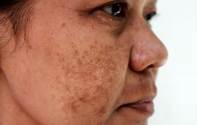 Melasma & Hyperpigmentation