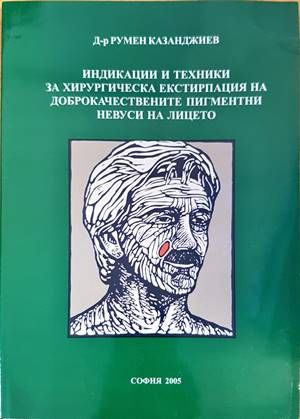 Индикации и техники за хирургическа екстирпация на доброкачествените пигментни невуси на лицето
