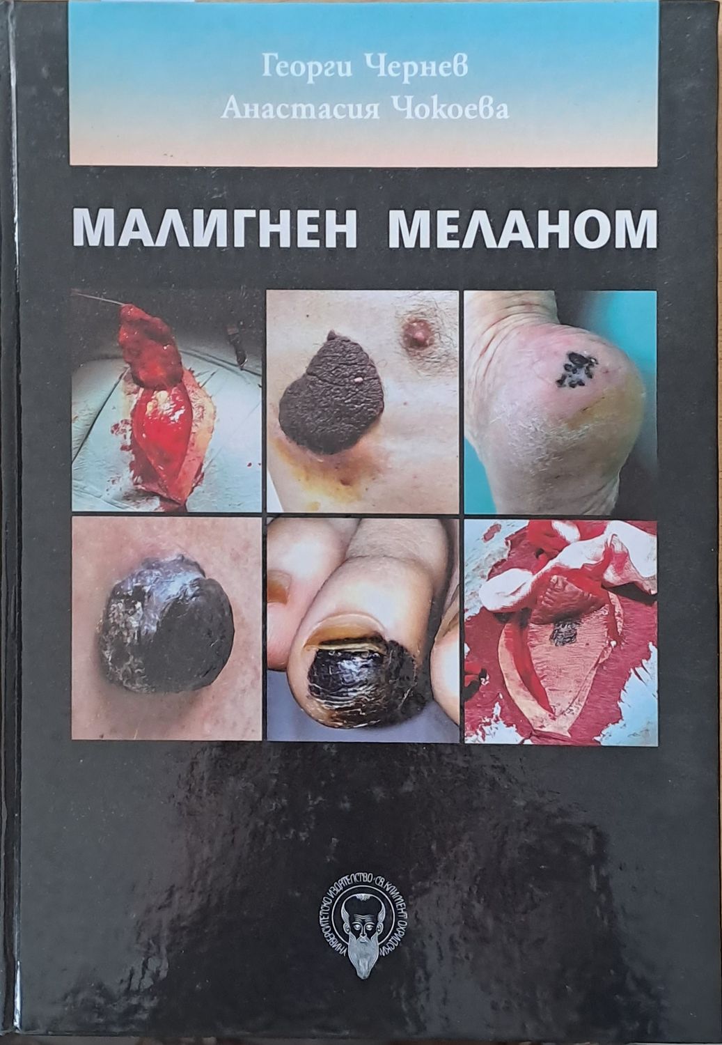 Малигнен меланом