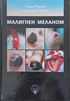 Малигнен меланом