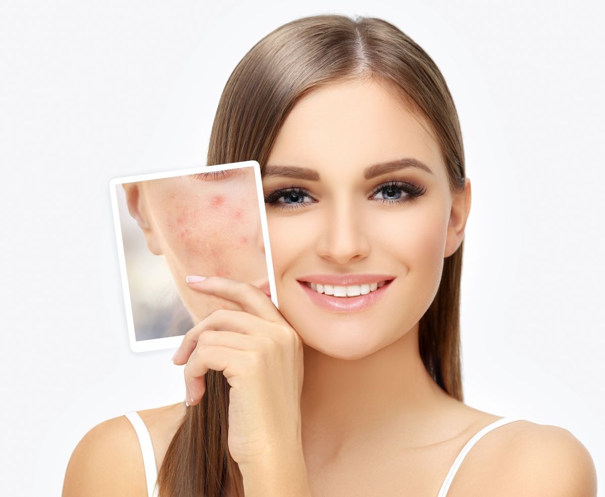 Mesopeel Melanostop Tramex (tratamiento para las manchas)