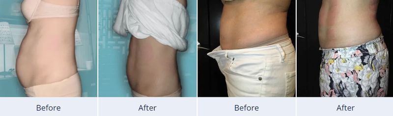 60min Elite Body Slimming - Stomach