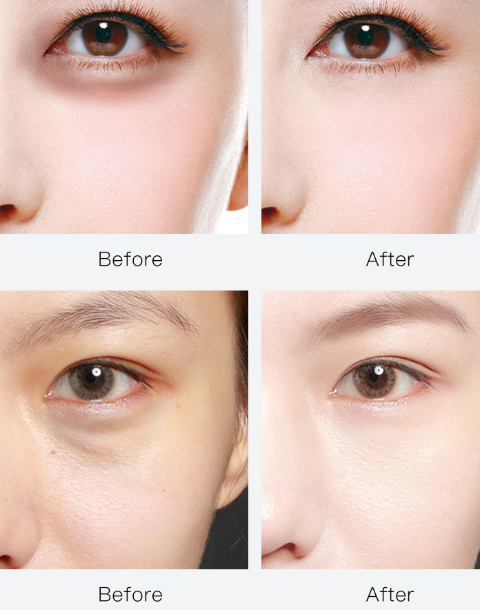 Патчи эффект до и после. Патчи до и после. Эффект от патчей под глаза. Патчи для глаз до и после. Глаза до и после патчей для глаз.