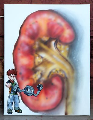 Kidney stone (Pierre au rein), original painting, 2025