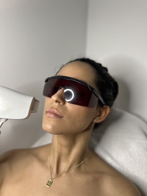 Laser Manchas Y Rosacea