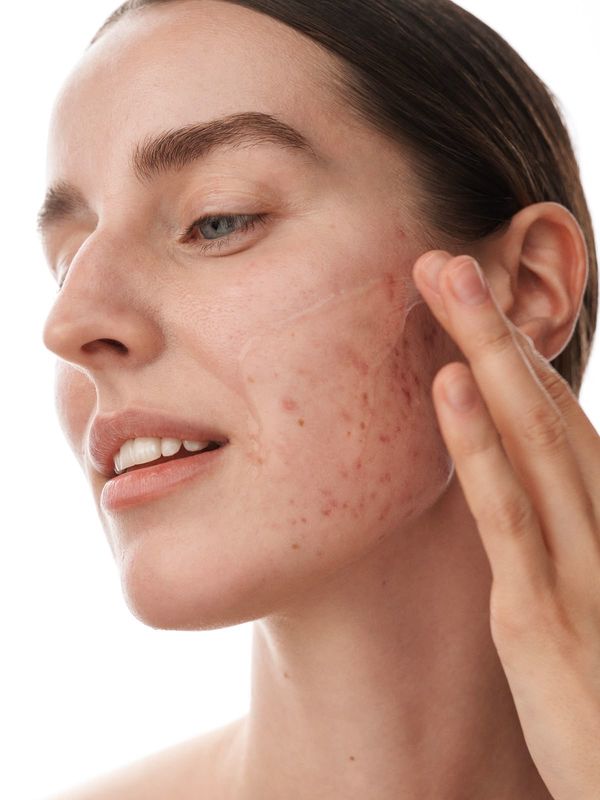 TRATTAMENTO ACNE