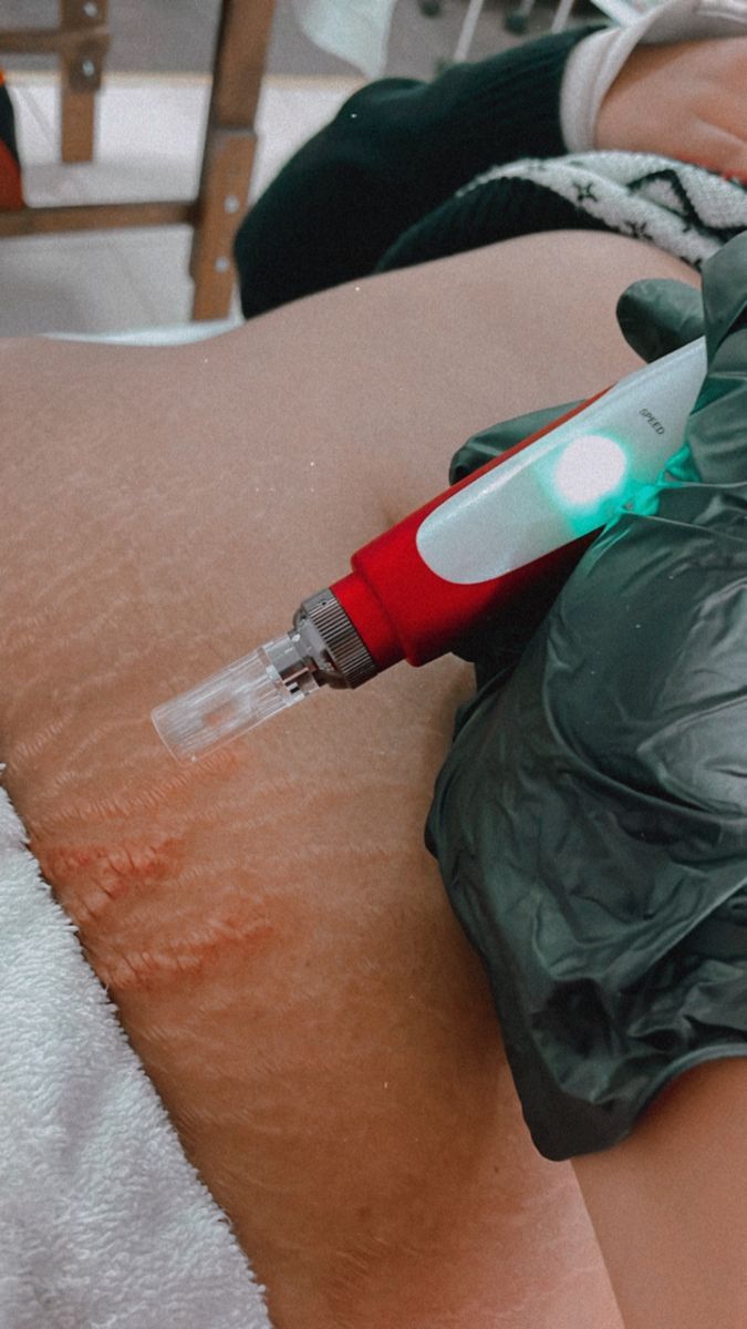 ​Body Stretch Mark Treatment