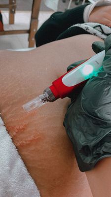 ​Body Stretch Mark Treatment