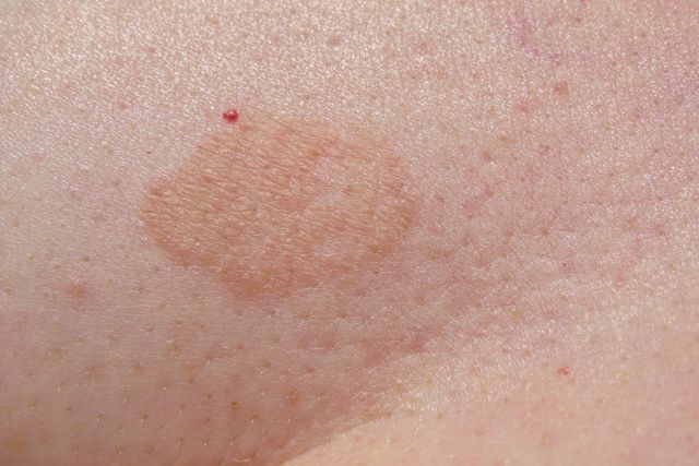 ​Skin Fungal Treatment