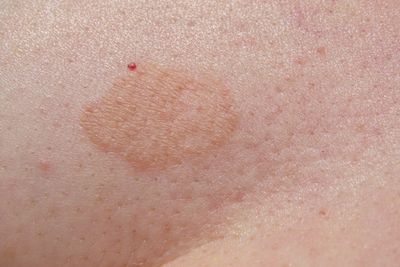 ​Skin Fungal Treatment