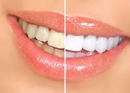 ​Teeth Whitening