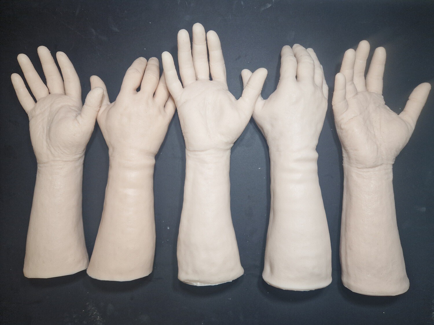 Defective forearm/wrist/hand