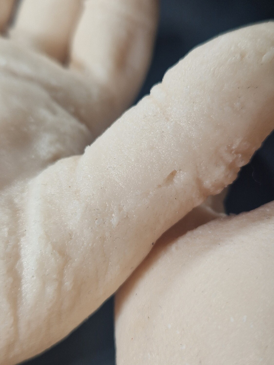 Defective forearm/wrist/hand