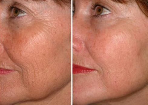 Microneedling