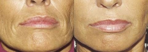 One Month Red Light Therapy