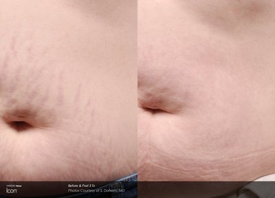 Laser Stretch Mark Removal