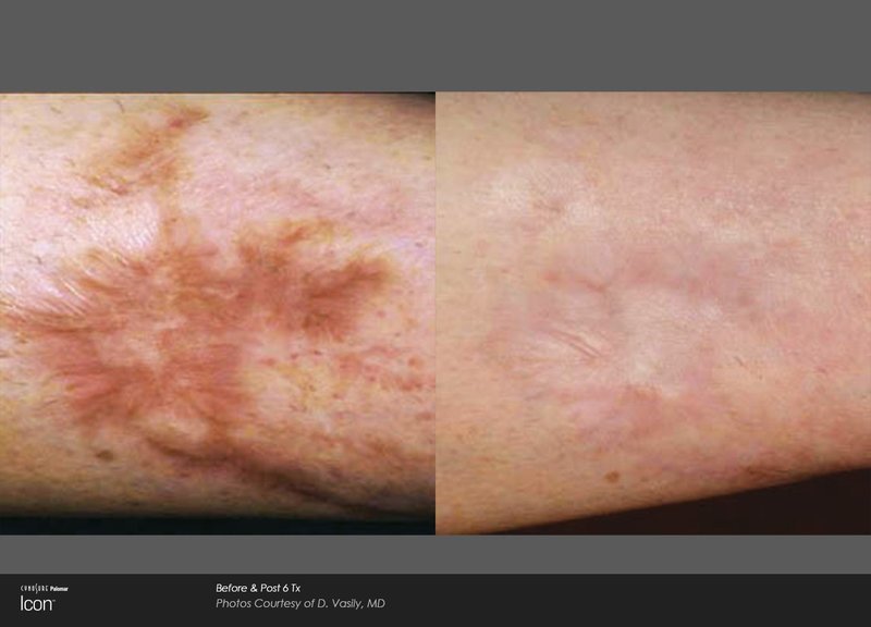 Laser Scar Removal