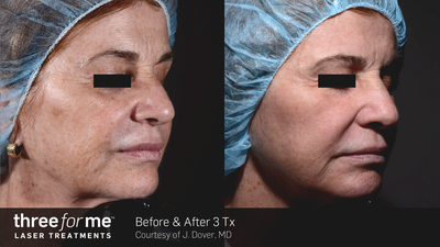 Laser Skin Resurfacing (Three For Me)