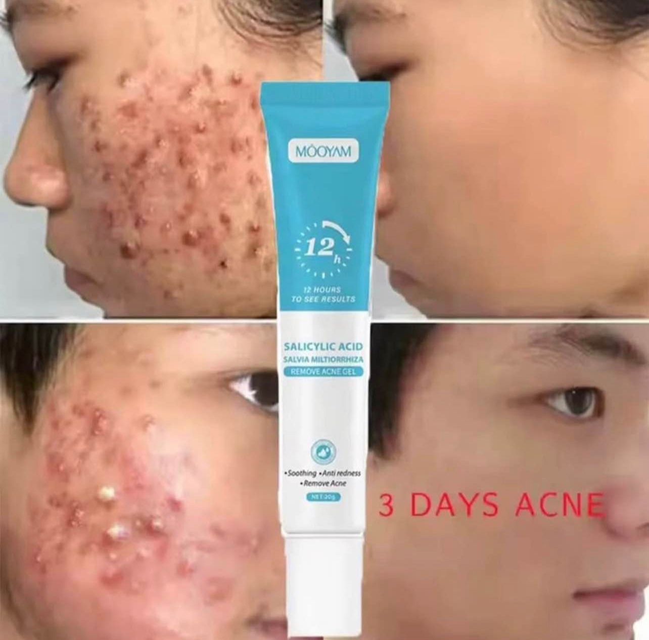 MOOYAM THE MOST EFFECTIVE ACNE REMOVAL.
